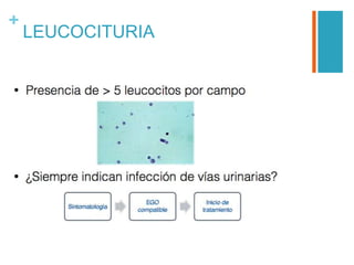 +
LEUCOCITURIA
 