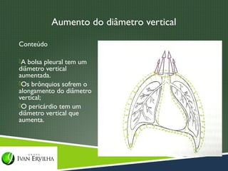 Aumento do diâmetro vertical

Conteúdo

A bolsa pleural tem um
diâmetro vertical
aumentada.
Os brônquios sofrem o
alongamento do diâmetro
vertical;
O pericárdio tem um
diâmetro vertical que
aumenta.
 