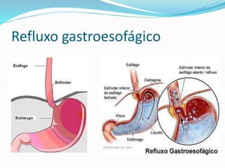 Refluxo gastroesofágico 
 