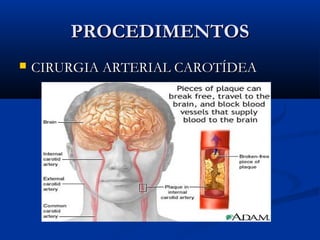 PROCEDIMENTOSPROCEDIMENTOS
 CIRURGIA ARTERIAL CAROTÍDEACIRURGIA ARTERIAL CAROTÍDEA
 