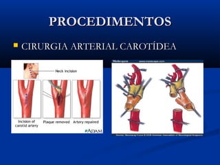 PROCEDIMENTOSPROCEDIMENTOS
 CIRURGIA ARTERIAL CAROTÍDEACIRURGIA ARTERIAL CAROTÍDEA
 
