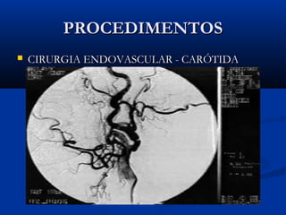 PROCEDIMENTOSPROCEDIMENTOS
 CIRURGIA ENDOVASCULAR - CARÓTIDACIRURGIA ENDOVASCULAR - CARÓTIDA
 