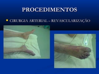 PROCEDIMENTOSPROCEDIMENTOS
 CIRURGIA ARTERIAL – REVASCULARIZAÇÃOCIRURGIA ARTERIAL – REVASCULARIZAÇÃO
 