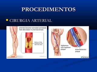 PROCEDIMENTOSPROCEDIMENTOS
 CIRURGIA ARTERIALCIRURGIA ARTERIAL
 