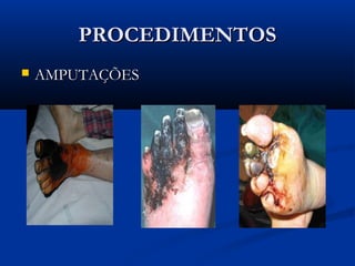 PROCEDIMENTOSPROCEDIMENTOS
 AMPUTAÇÕESAMPUTAÇÕES
 