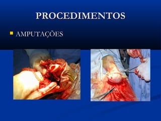 PROCEDIMENTOSPROCEDIMENTOS
 AMPUTAÇÕESAMPUTAÇÕES
 