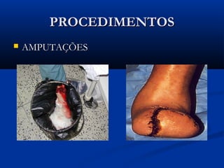 PROCEDIMENTOSPROCEDIMENTOS
 AMPUTAÇÕESAMPUTAÇÕES
 