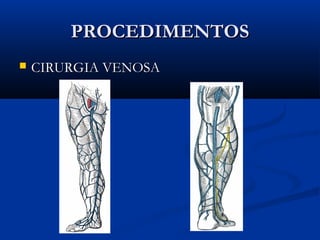 PROCEDIMENTOSPROCEDIMENTOS
 CIRURGIA VENOSACIRURGIA VENOSA
 