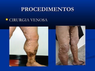PROCEDIMENTOSPROCEDIMENTOS
 CIRURGIA VENOSACIRURGIA VENOSA
 