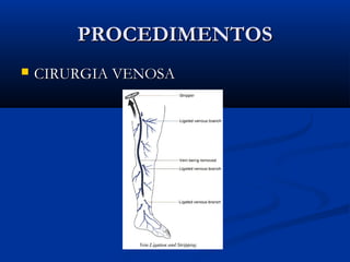 PROCEDIMENTOSPROCEDIMENTOS
 CIRURGIA VENOSACIRURGIA VENOSA
 