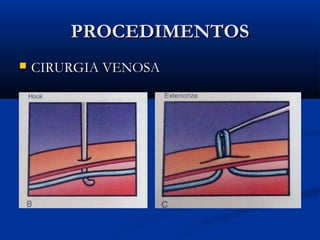 PROCEDIMENTOSPROCEDIMENTOS
 CIRURGIA VENOSACIRURGIA VENOSA
 