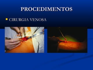 PROCEDIMENTOSPROCEDIMENTOS
 CIRURGIA VENOSACIRURGIA VENOSA
 