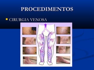 PROCEDIMENTOSPROCEDIMENTOS
 CIRURGIA VENOSACIRURGIA VENOSA
 