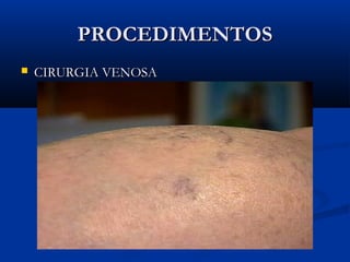 PROCEDIMENTOSPROCEDIMENTOS
 CIRURGIA VENOSACIRURGIA VENOSA
 