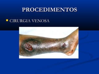 PROCEDIMENTOSPROCEDIMENTOS
 CIRURGIA VENOSACIRURGIA VENOSA
 