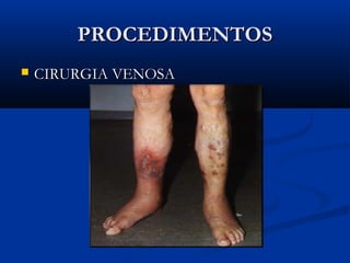 PROCEDIMENTOSPROCEDIMENTOS
 CIRURGIA VENOSACIRURGIA VENOSA
 
