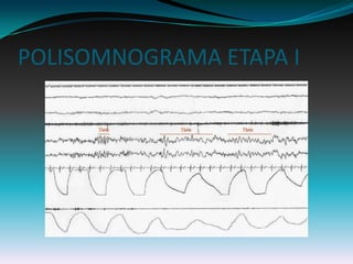 POLISOMNOGRAMA ETAPA I
 