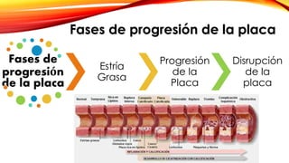 Fases de progresión de la placa 
Fases de 
progresión 
de la placa 
Estría 
Grasa 
Progresión 
de la 
Placa 
Disrupción 
de la 
placa 
 