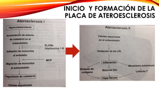 INICIO Y FORMACIÓN DE LA 
PLACA DE ATEROESCLEROSIS 
 