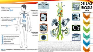 COMPLICACIONES DE LAS 
ATEROESCLEROSIS 
1. Calcificación de placa 
ateroesclerótica 
-Rigidez 
-Vasos frágiles 
2.Ruptura y ulceración de la 
placa 
-Exposición de procoagulantes 
-Trombo 
-Oclusión 
3. Hemorragia de la placa 
- por ruptura de cubierta 
fibrosa o microvasos 
4. Embolización del ateroma 
-Zonas vasculares distales 
5. Debilidad de pared de vasos: 
-Zona limítrofe: no hay flujo  
atrofia  pérdida de tejido 
elástico aneurisma 
Más 
afectadas: 
Parte dorsal 
de aorta 
abdominal 
coronarias 
proximales 
arterias 
poplíteas 
Arteria 
torácica 
descendente 
Arterias 
carótidas 
internas 
Arterias 
renales 
 