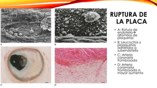 RUPTURA DE 
LA PLACA 
• A: Rotura de 
endotelio 
alfombra de 
plaquetas 
• B: Leucocitos y 
plaqquetas 
adheridos a 
subendotelio 
• C: Arteria 
coronaria 
trombosada 
• D: Arteria 
corornaria 
trombosada a 
mayor aumento 
 