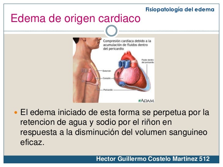 Fisiopatología del edema