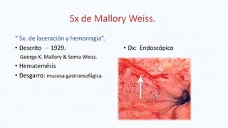 Sx de Mallory Weiss.
“ Sx. de laceración y hemorragia”.
• Descrito 1929.
George K. Mallory & Soma Weiss.
• Hematemésis
• Desgarro: mucosa gastroesofágica
• Dx: Endoscópico
 