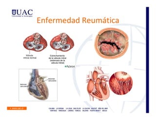 Enfermedad Reumática
 