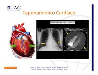 Taponamiento Cardíaco
 