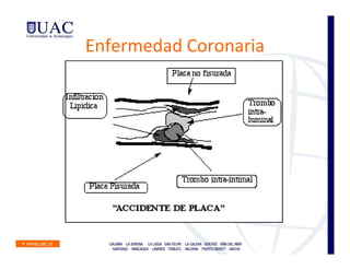 Enfermedad Coronaria
 