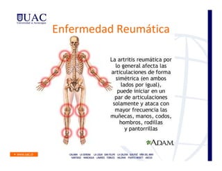 Enfermedad Reumática
 