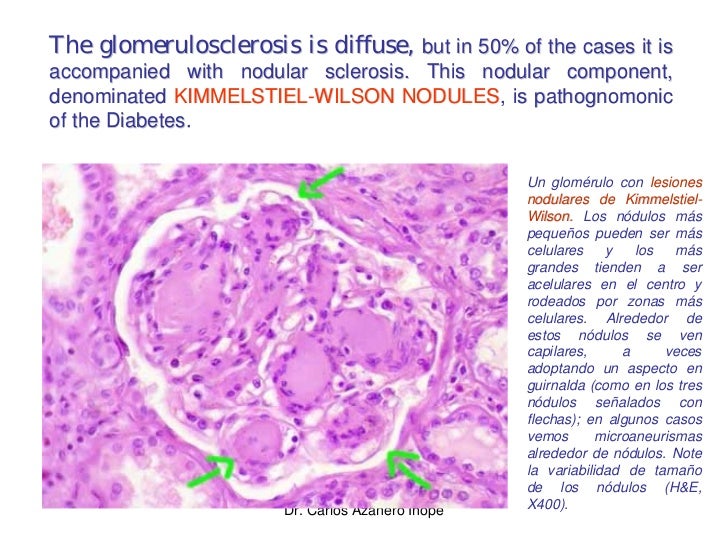 Pathophysiology of diabetic nephropathy