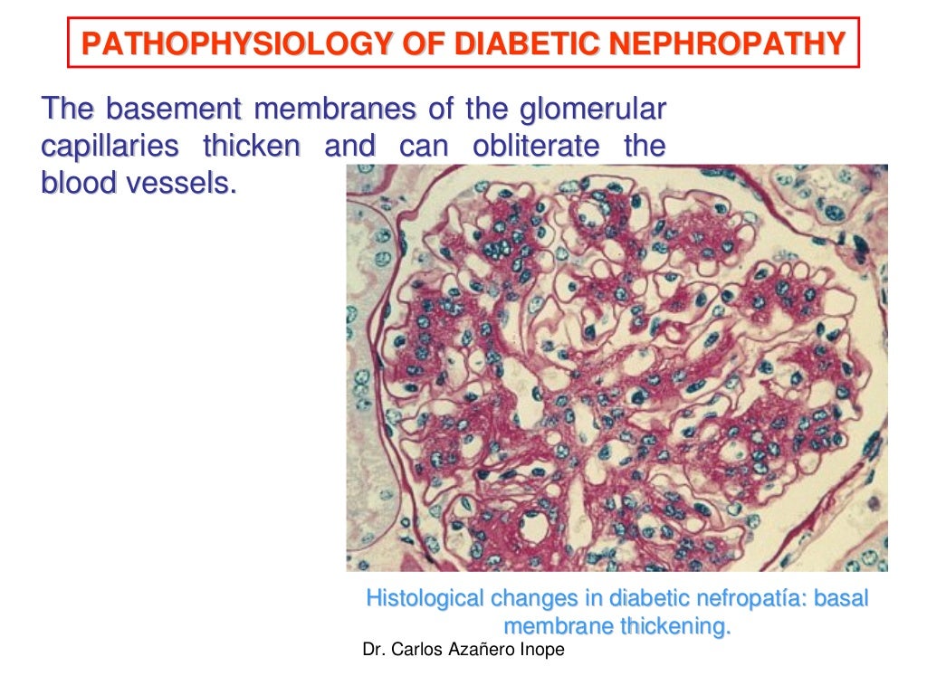 Pathophysiology of diabetic nephropathy