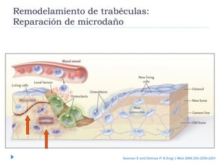 Seeman E and Delmas P. N Engl J Med 2006;354:2250-2261
Remodelamiento de trabéculas:
Reparación de microdaño
 