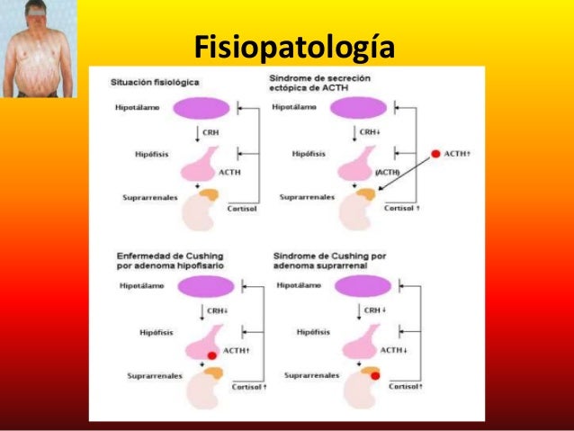 Fisiopatologia del sd de cushing Fisiopatologia del sd de cushing