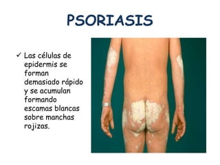 PSORIASIS 
 Las células de 
epidermis se 
forman 
demasiado rápido 
y se acumulan 
formando 
escamas blancas 
sobre manchas 
rojizas. 
 