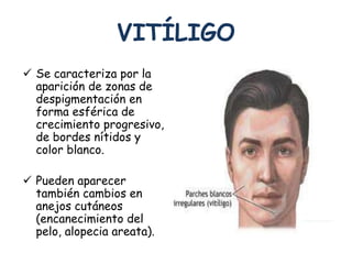 VITÍLIGO 
 Se caracteriza por la 
aparición de zonas de 
despigmentación en 
forma esférica de 
crecimiento progresivo, 
de bordes nítidos y 
color blanco. 
 Pueden aparecer 
también cambios en 
anejos cutáneos 
(encanecimiento del 
pelo, alopecia areata). 
 