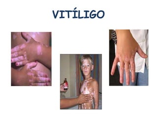 VITÍLIGO 
 