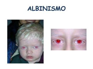 ALBINISMO 
 