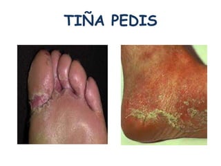 TIÑA PEDIS 
 