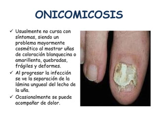 ONICOMICOSIS 
 Usualmente no cursa con 
síntomas, siendo un 
problema mayormente 
cosmético al mostrar uñas 
de coloración blanquecina o 
amarillenta, quebradas, 
frágiles y deformes. 
 Al progresar la infección 
se ve la separación de la 
lámina ungueal del lecho de 
la uña. 
 Ocasionalmente se puede 
acompañar de dolor. 
 