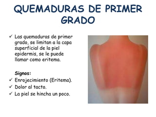 QUEMADURAS DE PRIMER 
GRADO 
 Las quemaduras de primer 
grado, se limitan a la capa 
superficial de la piel 
epidermis, se le puede 
llamar como eritema. 
Signos: 
 Enrojecimiento (Eritema). 
 Dolor al tacto. 
 La piel se hincha un poco. 
 