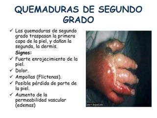 QUEMADURAS DE SEGUNDO 
GRADO 
 Las quemaduras de segundo 
grado traspasan la primera 
capa de la piel, y dañan la 
segunda, la dermis. 
Signos: 
 Fuerte enrojecimiento de la 
piel. 
 Dolor. 
 Ampollas (Flictenas). 
 Posible pérdida de parte de 
la piel. 
 Aumento de la 
permeabilidad vascular 
(edemas) 
 