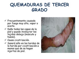 QUEMADURAS DE TERCER 
GRADO 
 Frecuentemente causada 
por fuego muy alto, vapor o 
aceite. 
 Daña todas las capas de la 
piel y puede involucrar los 
tejidos debajo (músculo y 
hueso). 
 Causa cicatrización. 
 Sanará sólo en los bordes de 
la herida por cicatrización a 
menos que de se hagan 
injertos de piel. 
 