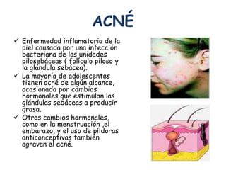 ACNÉ 
 Enfermedad inflamatoria de la 
piel causada por una infección 
bacteriana de las unidades 
pilosebáceas ( folículo piloso y 
la glándula sebácea). 
 La mayoría de adolescentes 
tienen acné de algún alcance, 
ocasionado por cambios 
hormonales que estimulan las 
glándulas sebáceas a producir 
grasa. 
 Otros cambios hormonales, 
como en la menstruación ,el 
embarazo, y el uso de píldoras 
anticonceptivas también 
agravan el acné. 
 