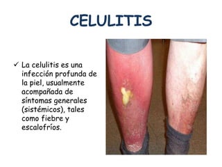 CELULITIS 
 La celulitis es una 
infección profunda de 
la piel, usualmente 
acompañada de 
síntomas generales 
(sistémicos), tales 
como fiebre y 
escalofríos. 
 