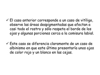  El caso anterior corresponde a un caso de vitíligo, 
observe las áreas despigmentadas que afectan a 
casi todo el rostro y sólo respeta el borde de los 
ojos y algunas porciones cerca a la comisura labial. 
 Este caso se diferencia claramente de un caso de 
albinismo en que este último presentaría unos ojos 
de color rojo y un blanco en las cejas. 
 