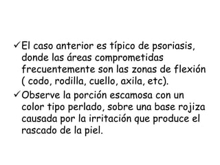El caso anterior es típico de psoriasis, 
donde las áreas comprometidas 
frecuentemente son las zonas de flexión 
( codo, rodilla, cuello, axila, etc). 
Observe la porción escamosa con un 
color tipo perlado, sobre una base rojiza 
causada por la irritación que produce el 
rascado de la piel. 
 