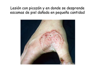 Lesión con picazón y en donde se desprende 
escamas de piel dañada en pequeña cantidad 
 