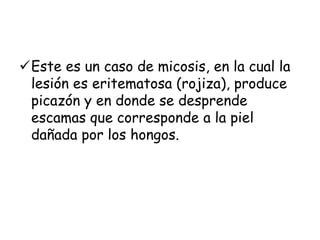 Este es un caso de micosis, en la cual la 
lesión es eritematosa (rojiza), produce 
picazón y en donde se desprende 
escamas que corresponde a la piel 
dañada por los hongos. 
 